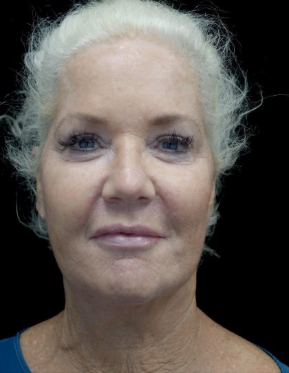 Facelift Before & After Patient #24508