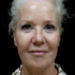 Facelift Before & After Patient #24508