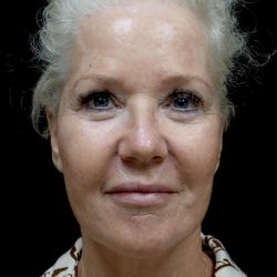 Facelift Before & After Patient #24508