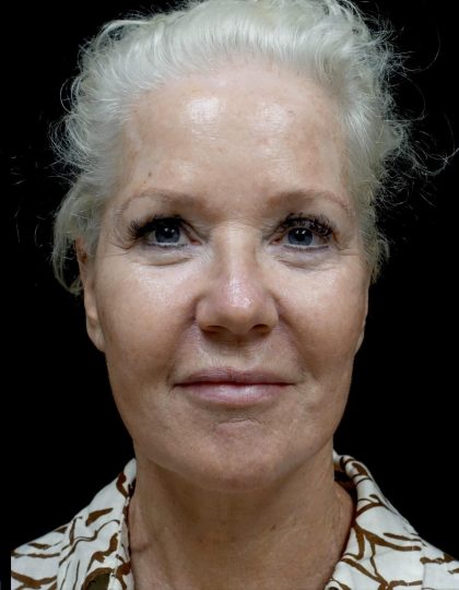 Facelift Before & After Patient #24508