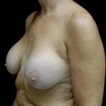 Breast Revision Before & After Patient #24515