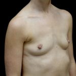Breast Augmentation (Implants) Before & After Patient #24517