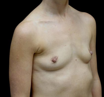 Breast Augmentation (Implants) Before & After Patient #24517