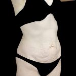Tummy Tuck Before & After Patient #24518