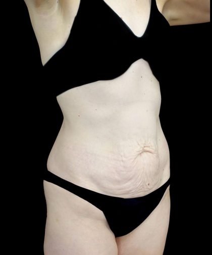 Tummy Tuck Before & After Patient #24518