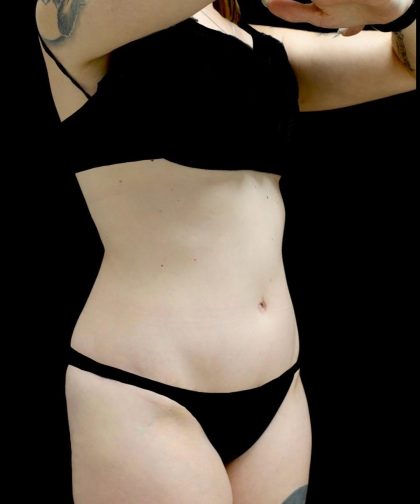 Tummy Tuck Before & After Patient #24518