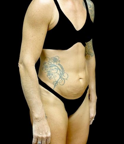 Tummy Tuck Before & After Patient #24576