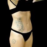 Tummy Tuck Before & After Patient #24576