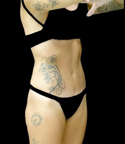 Tummy Tuck Before & After Patient #24576
