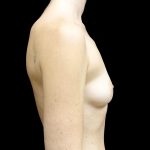 Breast Augmentation (Fat Transfer) Before & After Patient #24577