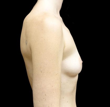 Breast Augmentation (Fat Transfer) Before & After Patient #24577