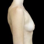 Breast Augmentation (Fat Transfer) Before & After Patient #24577