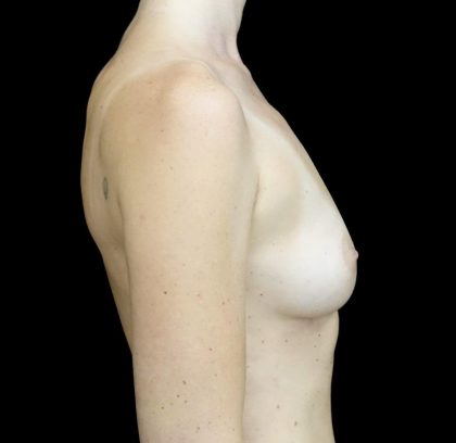 Breast Augmentation (Fat Transfer) Before & After Patient #24577
