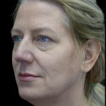 Blepharoplasty Before & After Patient #24578