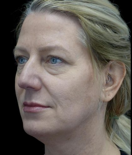 Blepharoplasty Before & After Patient #24578