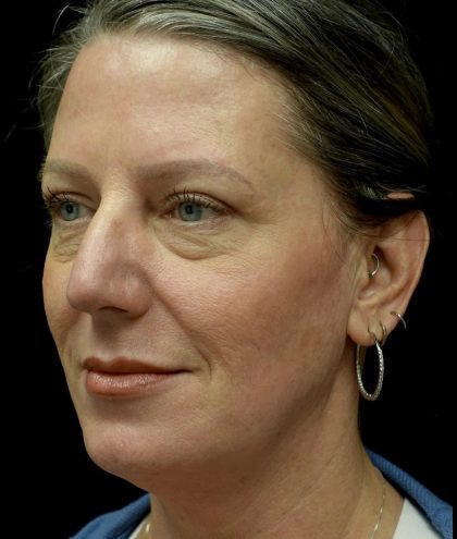 Blepharoplasty Before & After Patient #24578