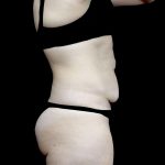 Tummy Tuck Before & After Patient #24579