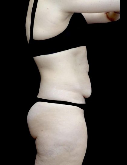 Tummy Tuck Before & After Patient #24579