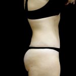 Tummy Tuck Before & After Patient #24579