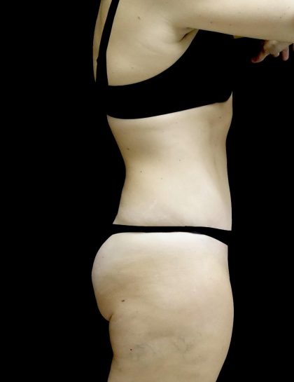 Tummy Tuck Before & After Patient #24579
