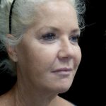 Facelift Before & After Patient #24508