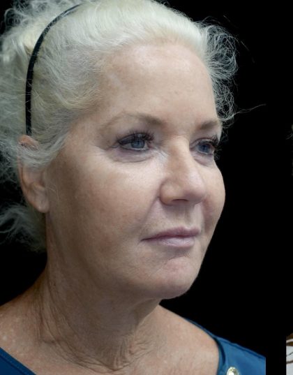 Facelift Before & After Patient #24508