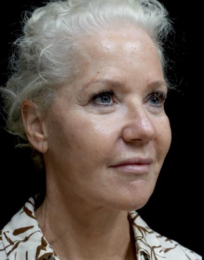 Facelift Before & After Patient #24508