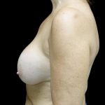 Breast Revision Before & After Patient #24515