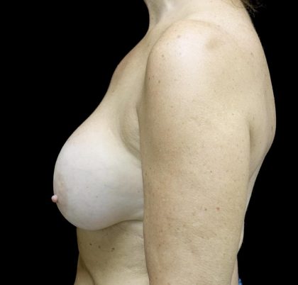 Breast Revision Before & After Patient #24515