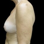 Breast Revision Before & After Patient #24515