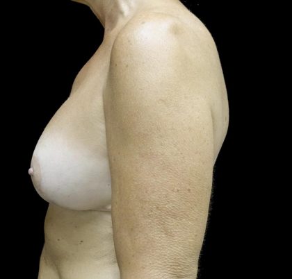 Breast Revision Before & After Patient #24515