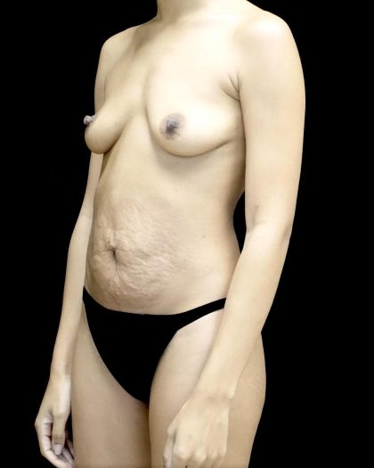 Breast Augmentation (Implants) Before & After Patient #24516