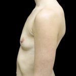 Breast Augmentation (Implants) Before & After Patient #24517