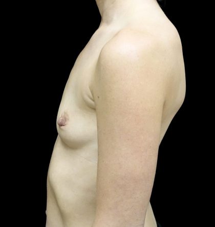 Breast Augmentation (Implants) Before & After Patient #24517