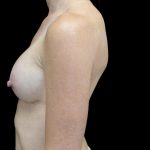 Breast Augmentation (Implants) Before & After Patient #24517