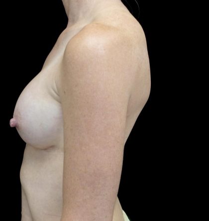 Breast Augmentation (Implants) Before & After Patient #24517