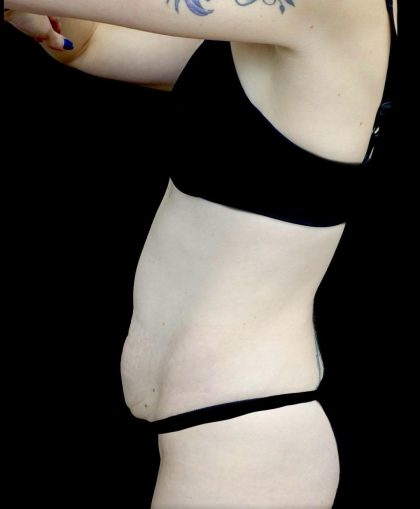 Tummy Tuck Before & After Patient #24518