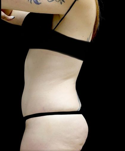 Tummy Tuck Before & After Patient #24518