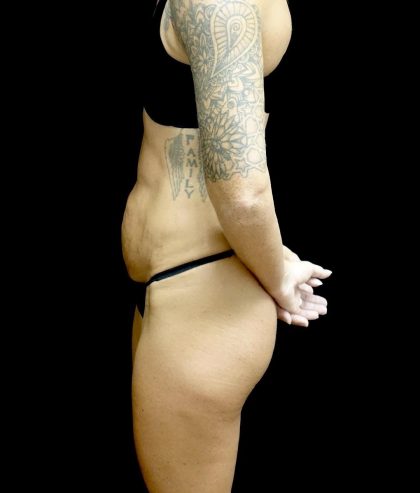 Tummy Tuck Before & After Patient #24576