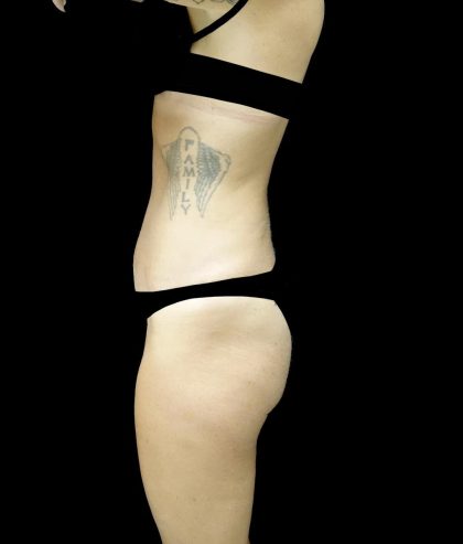 Tummy Tuck Before & After Patient #24576