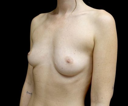 Breast Augmentation (Fat Transfer) Before & After Patient #24577