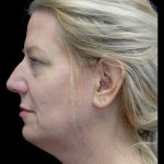 Blepharoplasty Before & After Patient #24578