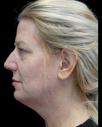 Blepharoplasty Before & After Patient #24578