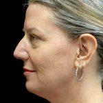 Blepharoplasty Before & After Patient #24578