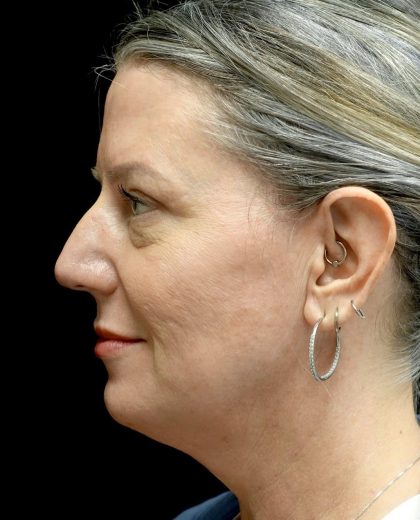 Blepharoplasty Before & After Patient #24578