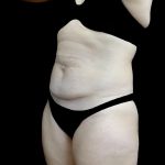 Tummy Tuck Before & After Patient #24579