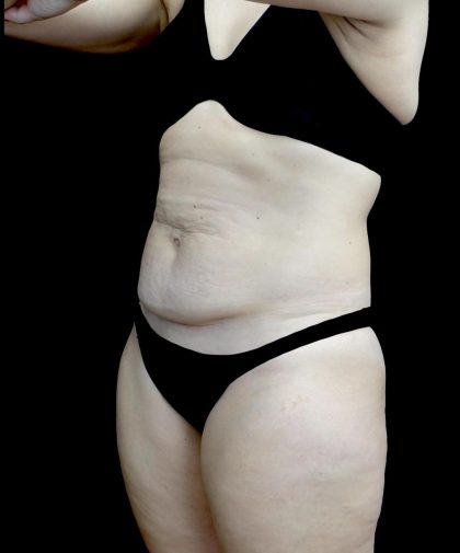 Tummy Tuck Before & After Patient #24579