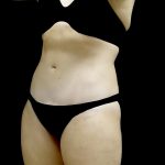 Tummy Tuck Before & After Patient #24579