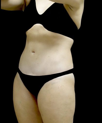 Tummy Tuck Before & After Patient #24579
