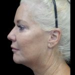 Facelift Before & After Patient #24508